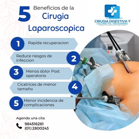 Ilustración de la técnica laparoscópica utilizada en cirugía bariátrica.