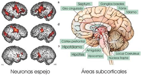 Esquema de un cerebro mostrando las áreas afectadas por infartos subcorticales y leucoencefalopatía en CADASIL