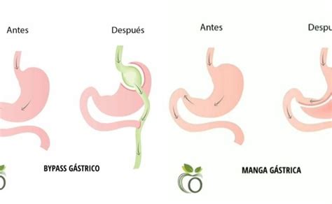 Ilustración comparativa de las técnicas de manga gástrica, bypass gástrico y balón intragástrico.