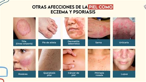 Infografía comparando síntomas del STC con otras afecciones de la mano