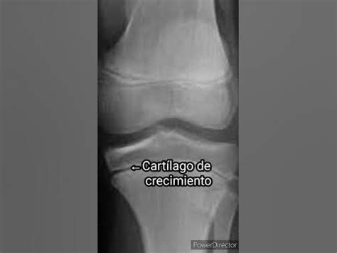 Radiografía mostrando cartílagos de crecimiento en huesos de un niño