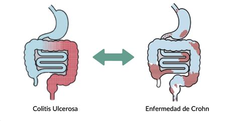 esquema comparativo de la enfermedad de Crohn y la colitis ulcerosa.