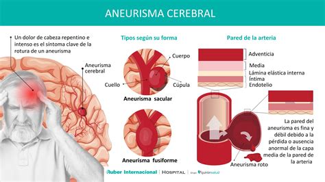 infografía explicando qué es un aneurisma cerebral y sus tipos