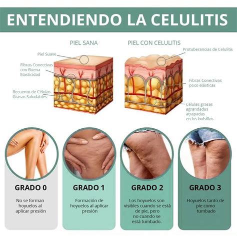 Gráfico ilustrando los diferentes tipos de celulitis y sus manifestaciones.