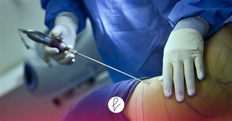 infografía comparativa de liposucción tradicional vs. liposucción de alta definición