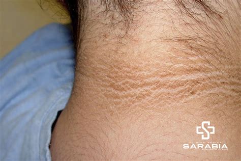 Diagrama que muestra las áreas comunes de aparición de Acantosis Nigricans en el cuerpo humano: cuello, axilas, ingles.