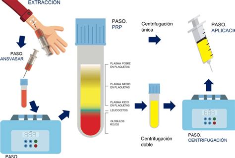 Diagrama que muestra el proceso de extracción de sangre para análisis.
