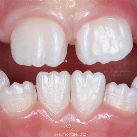 Técnica de estratificación para dar translucidez y marcar mamelones, disimulando la cofia de zirconio.