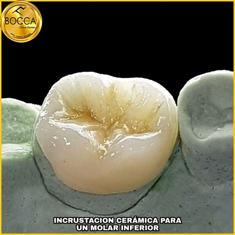 Integración natural de la incrustación cerámica en la arcada y adaptación a la pieza.