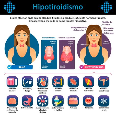 Infografía sobre los síntomas y tratamiento del hipotiroidismo