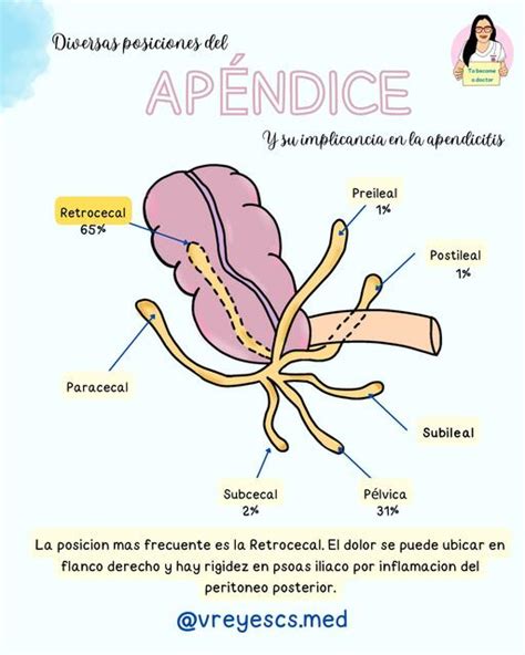 Diagrama anatómico del apéndice vermiforme y su localización en el abdomen.