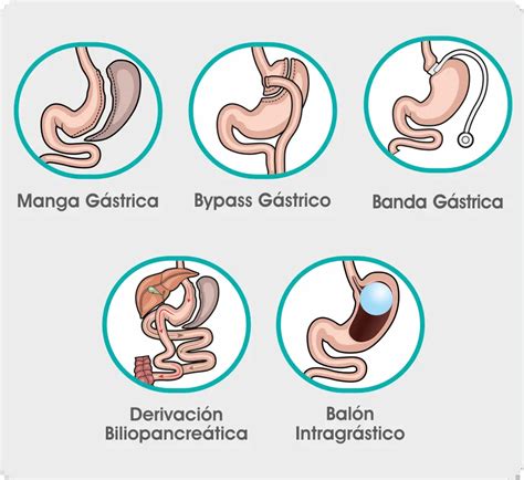 Gráfico mostrando la evolución de los tipos de cirugía bariátrica.