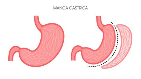 Diagrama del procedimiento de manga gástrica, mostrando la porción del estómago que se extirpa y la forma tubular resultante.