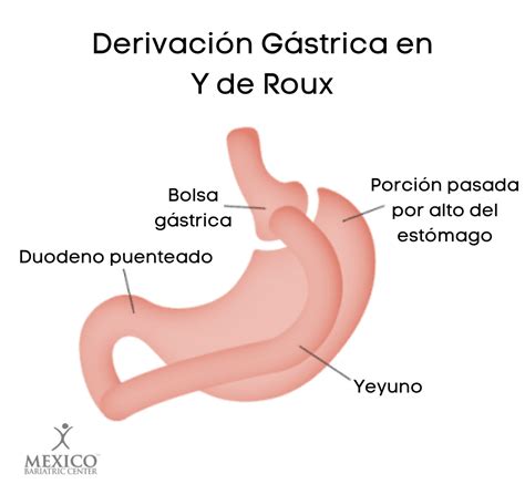 Esquema de la derivación gastroyeyunal en Y de Roux