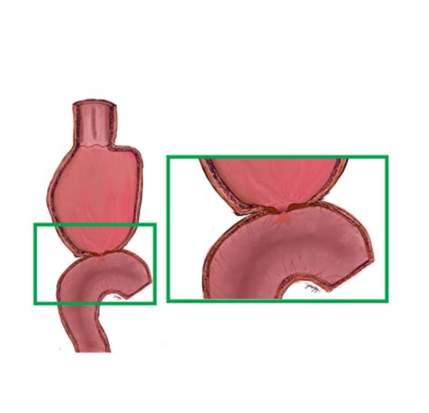 Estenosis de anastomosis gastroyeyunal