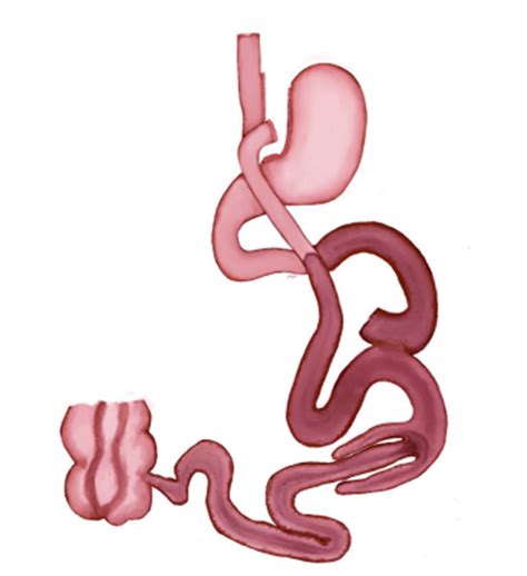 Intususcepción del asa eferente en dirección hacia la anastomosis yeyuno yeyunal