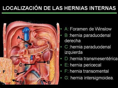 Hernias internas con asa de Roux antecólica