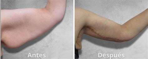 Galería de fotos de antes y después de liposucción de axilas, mostrando la eliminación de grasa localizada y la mejora del contorno.