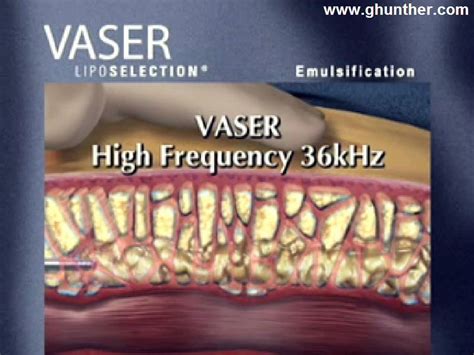 Representación gráfica del funcionamiento de la tecnología Vaser Lipo®, mostrando cómo las ondas ultrasónicas licúan la grasa.