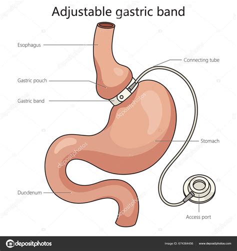Infografía sobre el funcionamiento de una banda gástrica ajustable