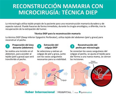 Comparativa visual de una mama reconstruida con DIEP y una mama reconstruida con implante, destacando la naturalidad del tejido autólogo.