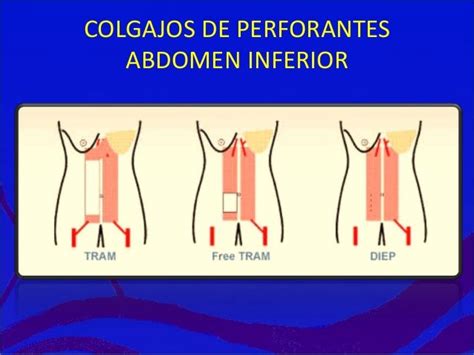 Infografía mostrando diferentes tipos de colgajos autólogos para reconstrucción mamaria (DIEP, TRAM, TUG, PAP, SGAP).