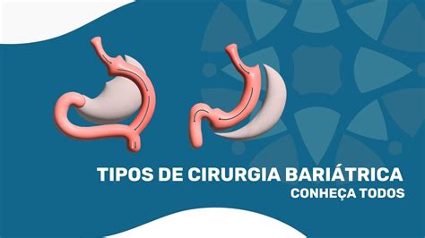 Infografía que muestra los diferentes tipos de cirugía bariátrica con su duración estimada.