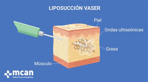 Infografía que muestra el funcionamiento de la tecnología VASER en la liposucción, destacando la emulsificación de la grasa.