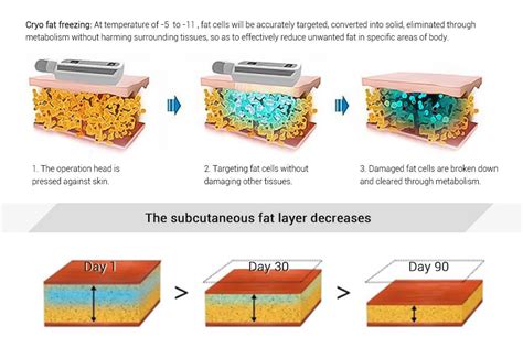 Ilustración mostrando el proceso de criolipólisis de CoolSculpting® y las zonas corporales tratadas.