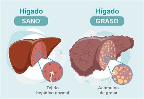 Infografía comparativa de un hígado sano y un hígado graso, mostrando depósitos de grasa y posible inflamación.
