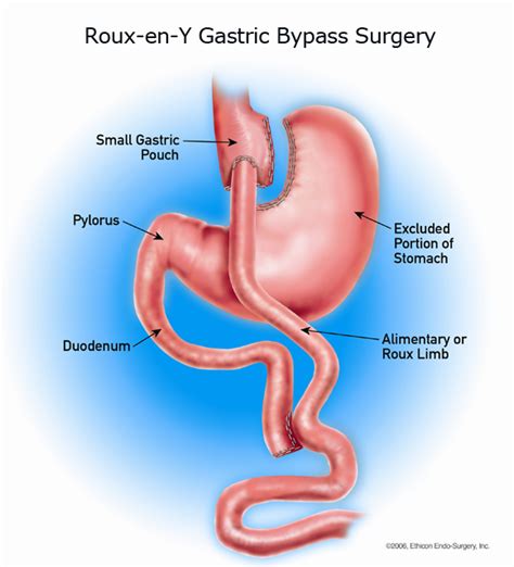 Diagrama del procedimiento de Bypass Gástrico en Y de Roux.