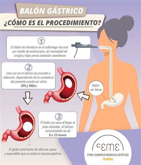 Ilustración de la colocación de un balón gástrico en el estómago.