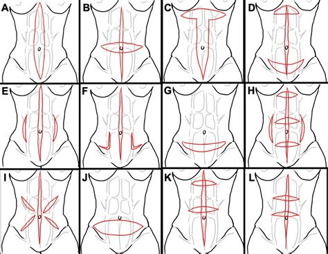 Esquema de los pasos quirúrgicos de una abdominoplastia, mostrando las incisiones y la plicatura muscular.
