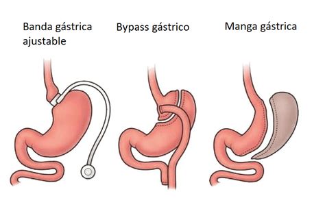 Infografía comparativa de las diferentes técnicas de cirugía bariátrica restrictiva, destacando el balón gástrico, la banda gástrica y la manga gástrica.