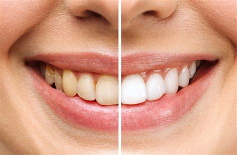 Imagen comparativa de dientes con y sin manchas de café, y cómo una pasta dental blanqueadora puede ayudar.