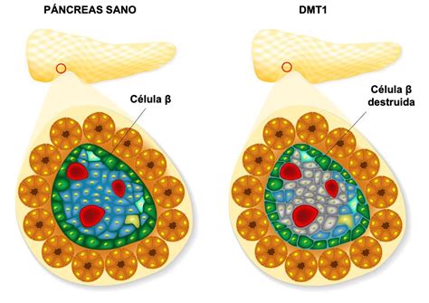 Esquema del páncreas y las células beta productoras de insulina.