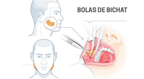 Diagrama anatómico del rostro humano, señalando las bolas de Bichat y las zonas de aplicación de rellenos y estimuladores de colágeno.