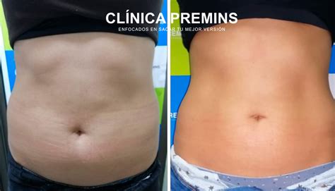 Galería de imágenes: Antes y después de tratamientos de hidrolipoclasia abdominal