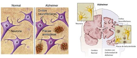 Representación esquemática de la acumulación de beta-amiloide en el Alzheimer y el rol de la BHE