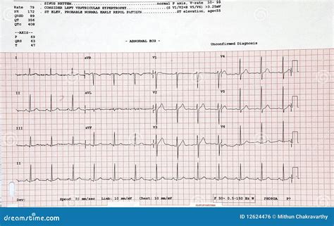 Imagen de electrocardiograma de la paciente, destacando posibles anomalías cardíacas.