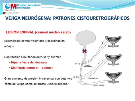 Esquema comparativo de patrones de lesión cerebral en EHI según edad gestacional y severidad