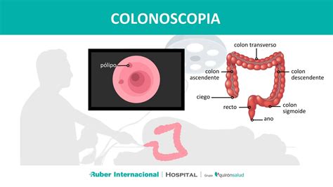 Ilustración mostrando el proceso de colonoscopia con toma de biopsias para el diagnóstico de colitis microscópica.