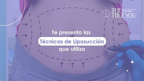 Ilustración detallada de las diferentes técnicas de liposucción.