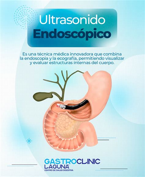 infografía detallando el procedimiento endoscópico del método Apollo, mostrando cómo se realizan las suturas en el estómago a través de un endoscopio.
