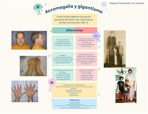 Ilustración que muestra las diferencias físicas entre gigantismo y acromegalia, destacando el alargamiento óseo en el gigantismo y la deformación ósea en la acromegalia.