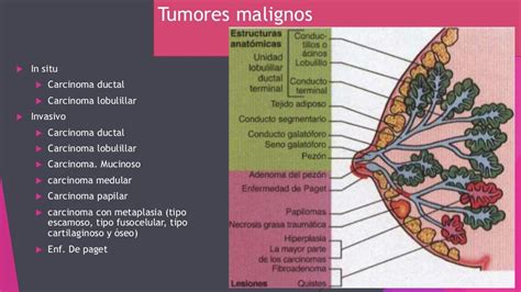 Representación esquemática de una mama con tumoraciones y supuración.