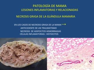 Ilustración médica que compara la apariencia radiológica de la necrosis grasa mamaria y el cáncer de mama.