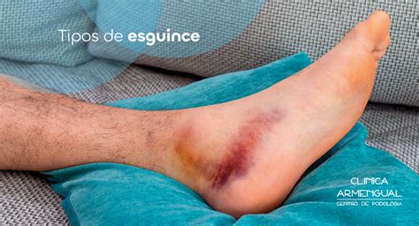 Infografía comparativa de esguinces, torceduras y contusiones, mostrando la afectación de ligamentos, músculos y tejidos blandos respectivamente.