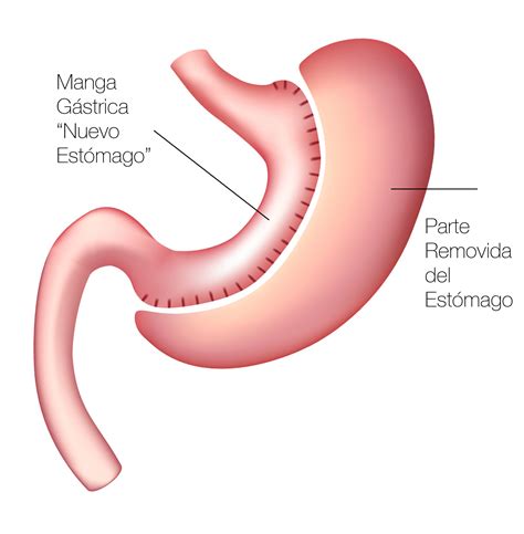 Diagrama que muestra el estómago antes y después de una manga gástrica.