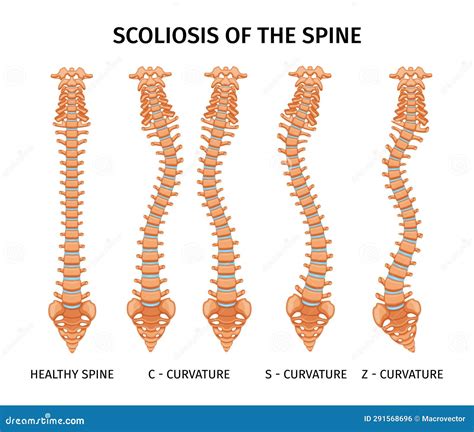 Ilustración comparativa de diferentes tipos de corsés para escoliosis: Wilmington, Boston y Rigo-Cheneau.